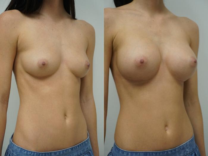 Before & After Breast Augmentation Case 92 View #2 View in Gilbert, AZ