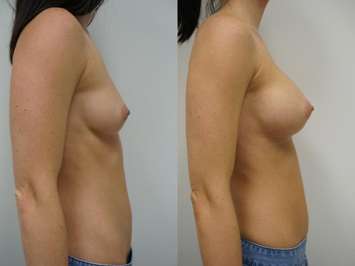 Before & After Breast Augmentation Case 92 View #3 View in Gilbert, AZ