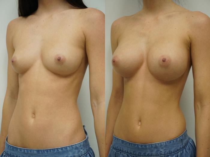 Before & After Breast Augmentation Case 92 View #4 View in Gilbert, AZ