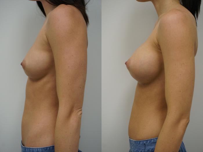 Before & After Breast Augmentation Case 92 View #5 View in Gilbert, AZ