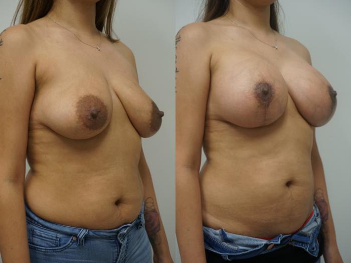Before & After Breast Augmentation with Breast Lift  Case 179 View #1 View in Gilbert, AZ