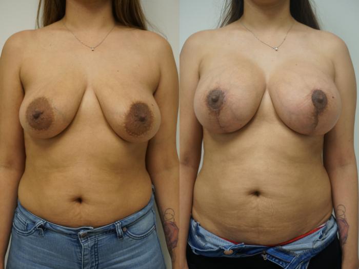 Before & After Breast Augmentation with Breast Lift  Case 179 View #2 View in Gilbert, AZ