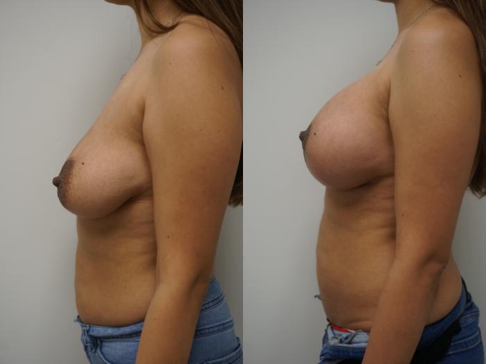 Before & After Breast Augmentation with Breast Lift  Case 179 View #3 View in Gilbert, AZ