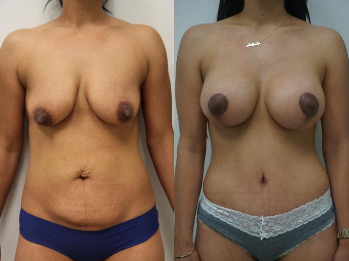 Before & After Breast Augmentation with Breast Lift  Case 185 View #1 View in Gilbert, AZ