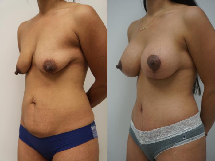 Before & After Breast Augmentation with Breast Lift  Case 185 View #2 View in Gilbert, AZ