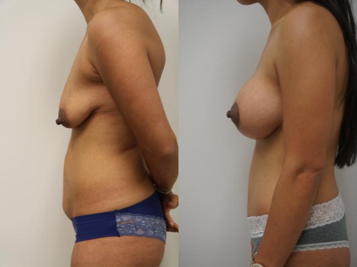 Before & After Breast Augmentation with Breast Lift  Case 185 View #3 View in Gilbert, AZ