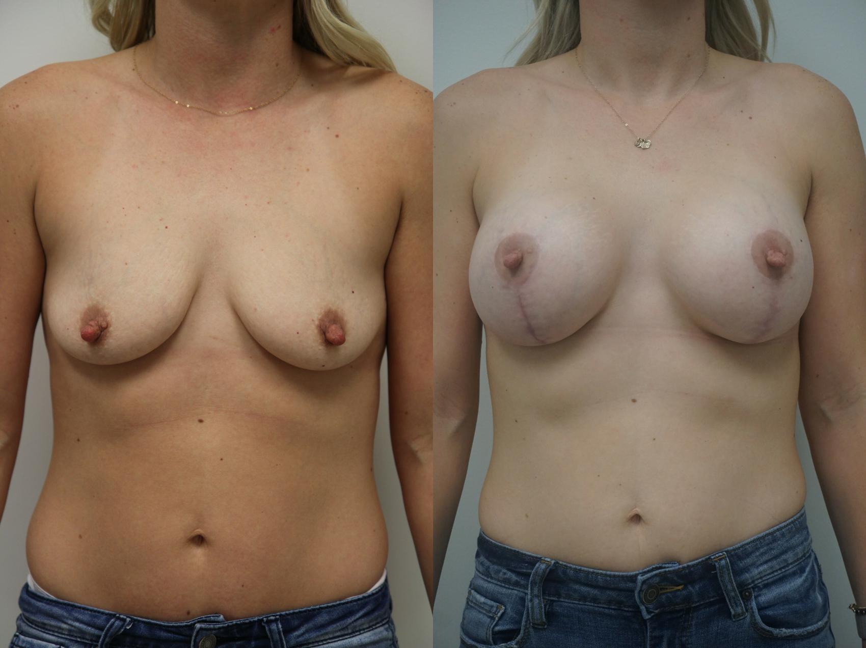 Before & After Breast Augmentation with Breast Lift  Case 232 View #2 View in Gilbert, AZ