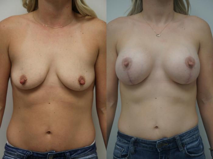 Before & After Breast Augmentation with Breast Lift  Case 232 View #2 View in Gilbert, AZ