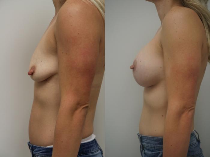 Before & After Breast Augmentation with Breast Lift  Case 232 View #3 View in Gilbert, AZ