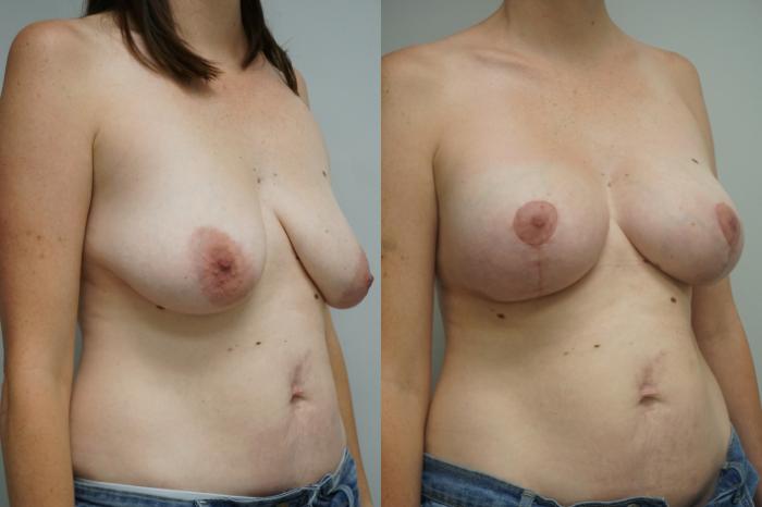 Before & After Breast Augmentation with Breast Lift  Case 284 Right Oblique View in Gilbert, AZ
