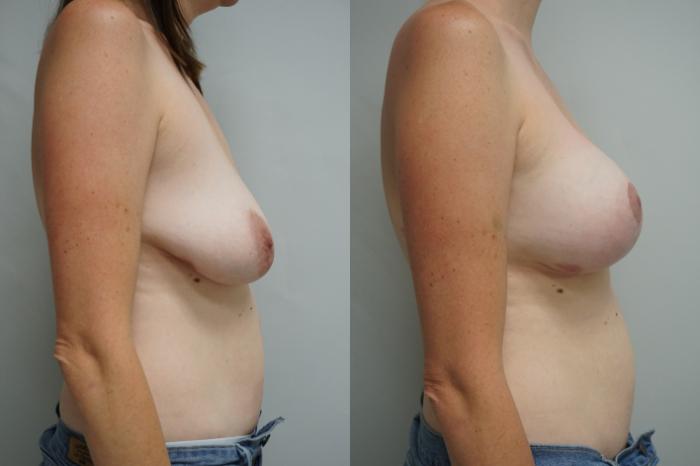 Before & After Breast Augmentation with Breast Lift  Case 284 Right Side View in Gilbert, AZ