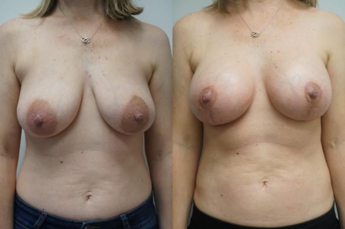 Before & After Breast Augmentation with Breast Lift  Case 285 Front View in Gilbert, AZ