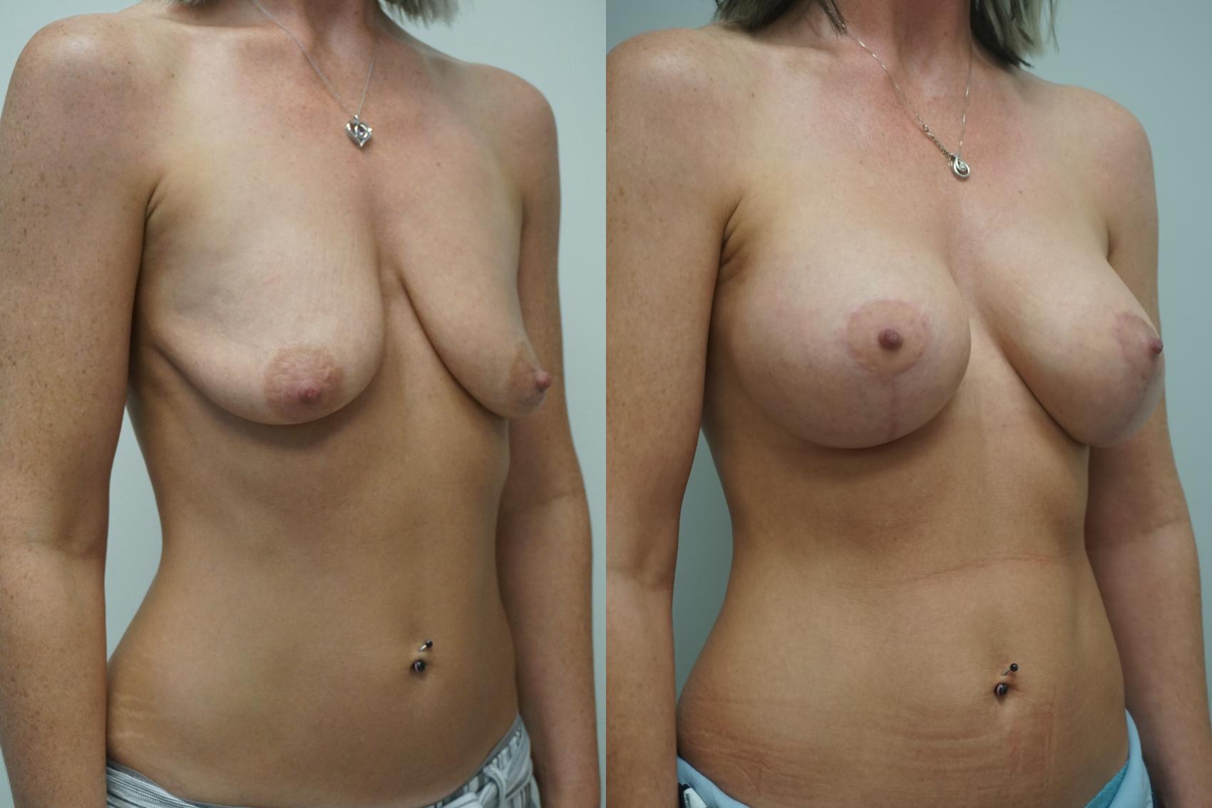 Before & After Breast Augmentation with Breast Lift  Case 289 Right Oblique View in Gilbert, AZ