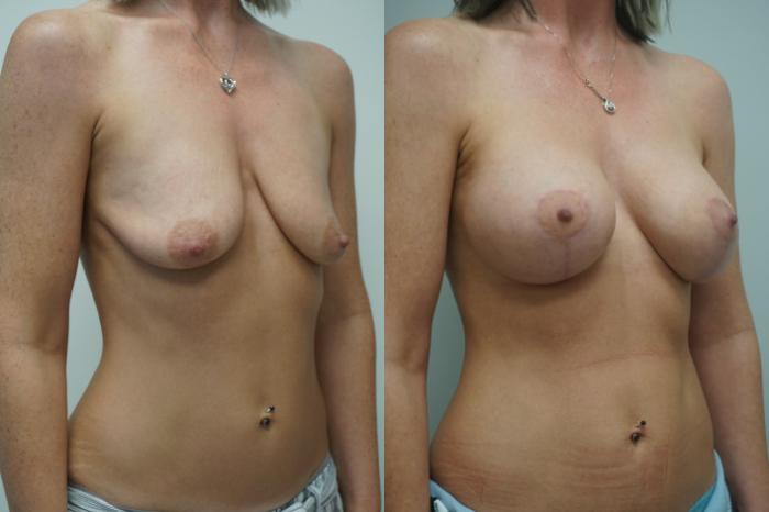 Before & After Breast Augmentation with Breast Lift  Case 289 Right Oblique View in Gilbert, AZ