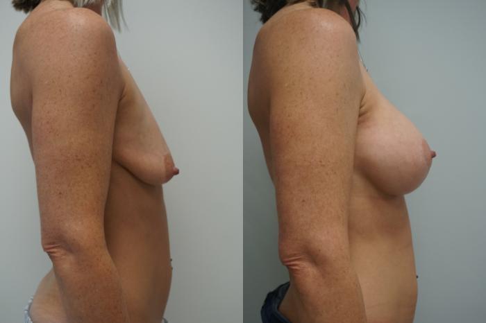 Before & After Breast Augmentation with Breast Lift  Case 289 Right Side View in Gilbert, AZ