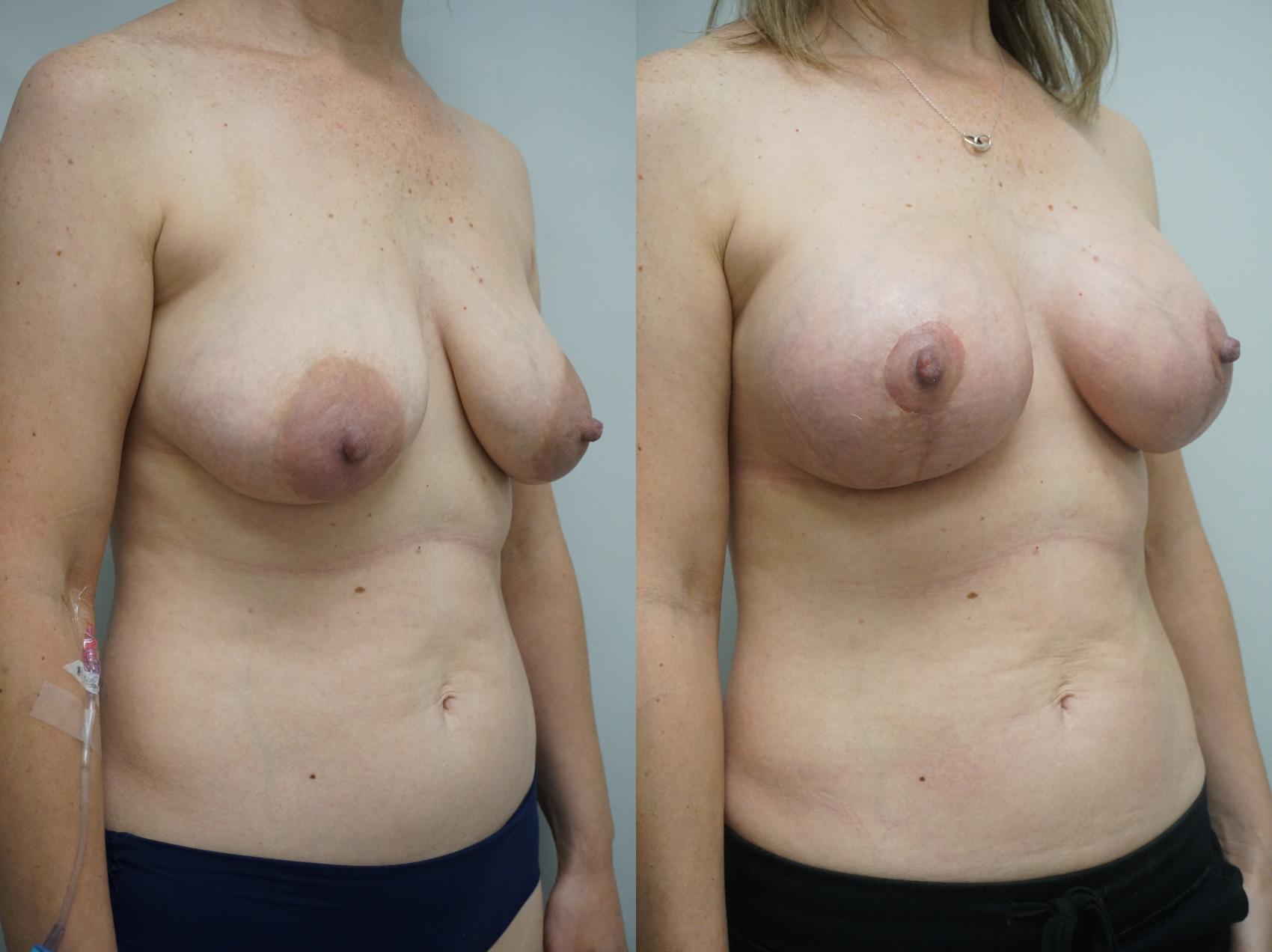 Before & After Breast Augmentation with Breast Lift  Case 305 Right Oblique View in Gilbert, AZ