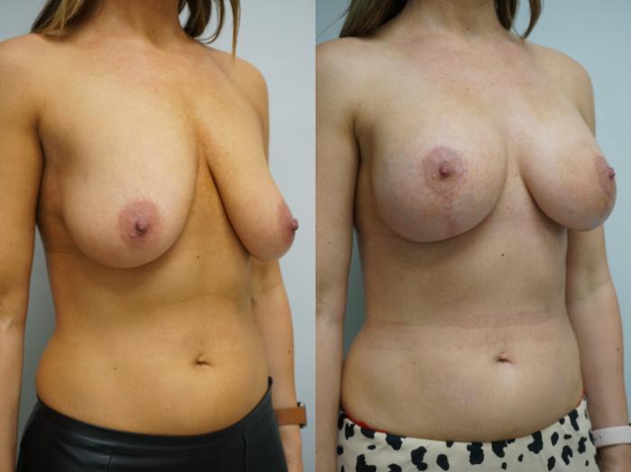 Before & After Breast Augmentation with Breast Lift  Case 309 Right Oblique View in Gilbert, AZ