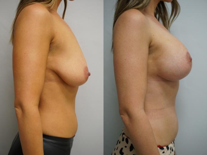 Before & After Breast Augmentation with Breast Lift  Case 309 Right Side View in Gilbert, AZ