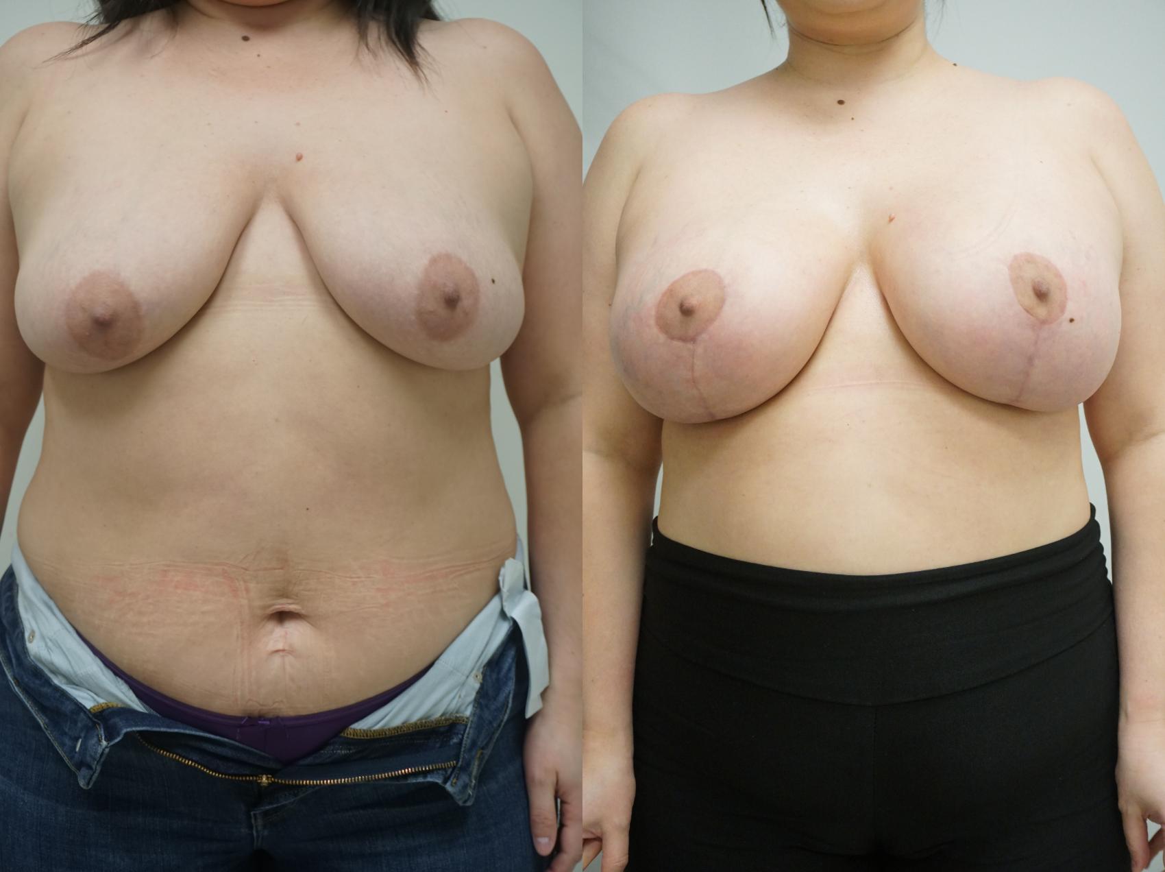Before & After Breast Augmentation with Breast Lift  Case 321 Front View in Gilbert, AZ