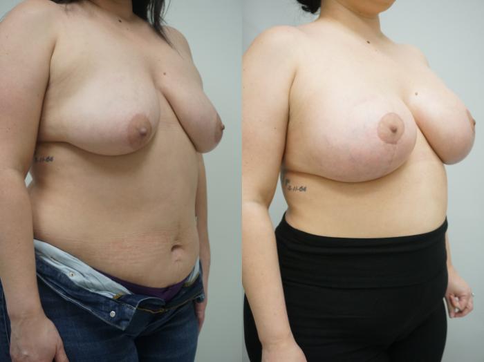 Before & After Breast Augmentation with Breast Lift  Case 321 Right Oblique View in Gilbert, AZ