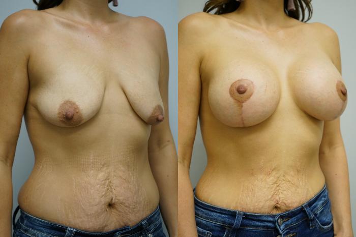 Before & After Breast Augmentation with Breast Lift  Case 359 Right Oblique View in Gilbert, AZ