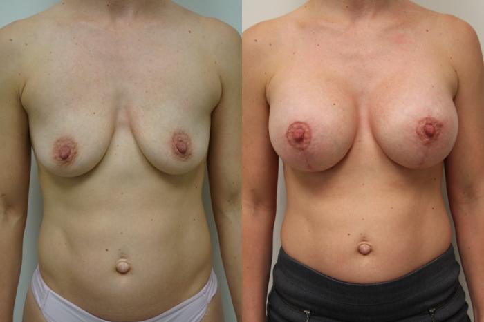 Before & After Breast Augmentation with Breast Lift  Case 412 Front View in Gilbert, AZ