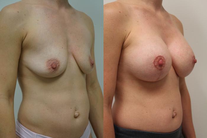 Before & After Breast Augmentation with Breast Lift  Case 412 Right Oblique View in Gilbert, AZ