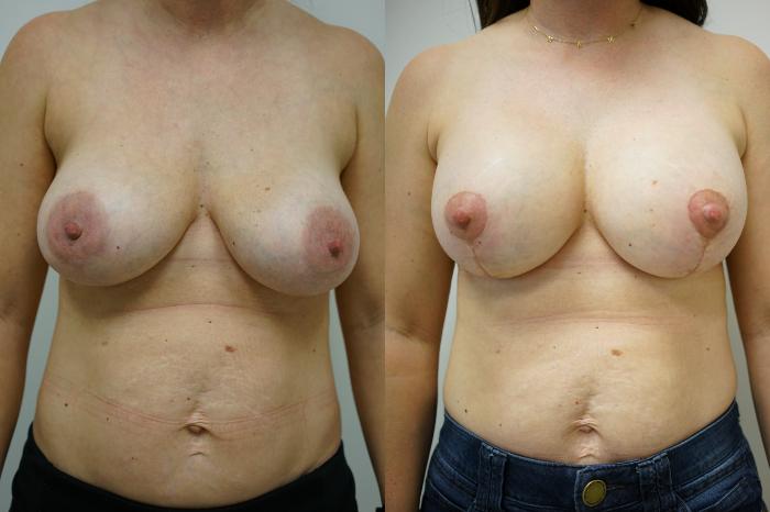 Before & After Breast Augmentation with Breast Lift  Case 441 Front View in Gilbert, AZ