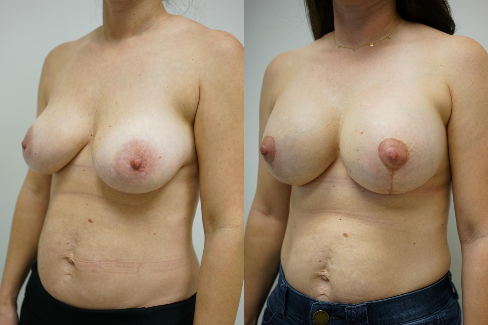 Before & After Breast Augmentation with Breast Lift  Case 441 Left Oblique View in Gilbert, AZ