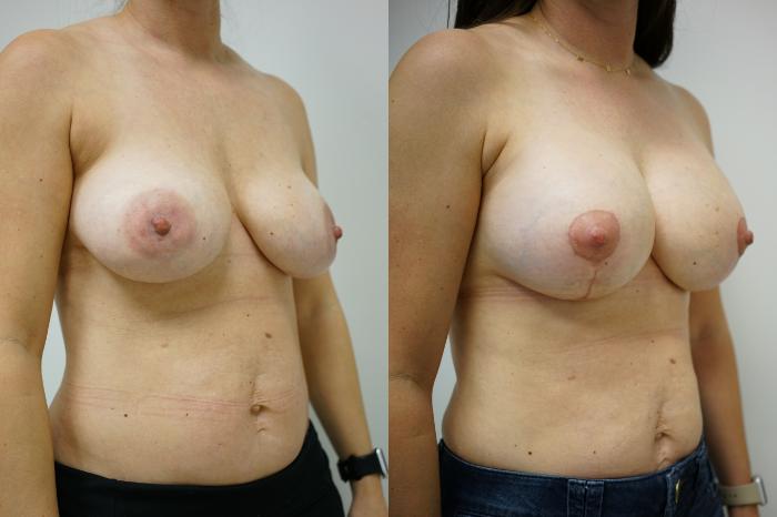 Before & After Breast Augmentation with Breast Lift  Case 441 Right Oblique View in Gilbert, AZ