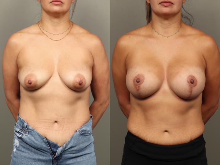 Before & After Breast Augmentation with Breast Lift  Case 476 Front View in Gilbert, AZ