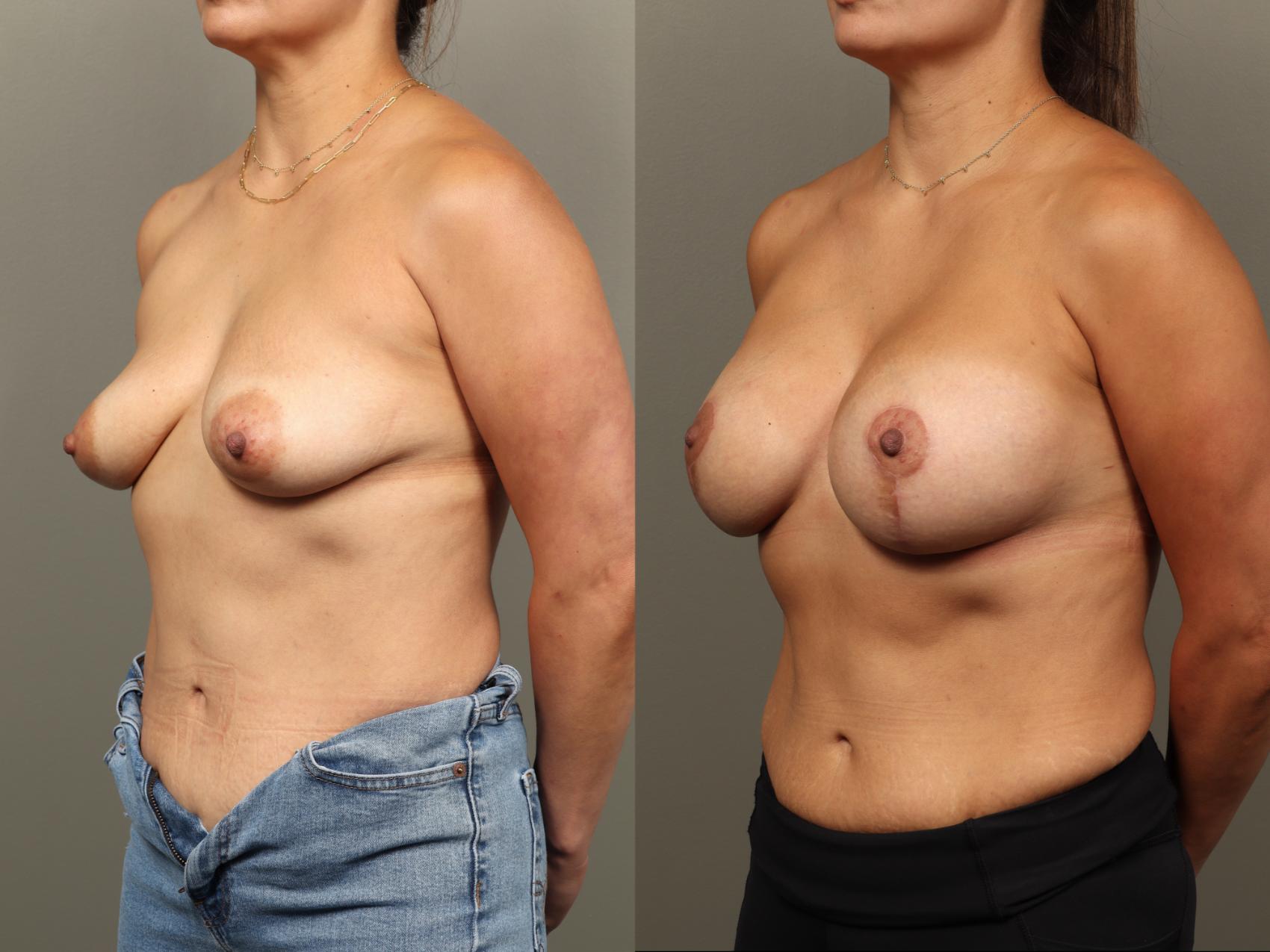 Before & After Breast Augmentation with Breast Lift  Case 476 Left Oblique View in Gilbert, AZ