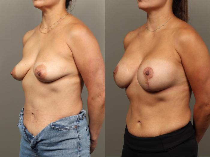 Before & After Breast Augmentation with Breast Lift  Case 476 Left Oblique View in Gilbert, AZ