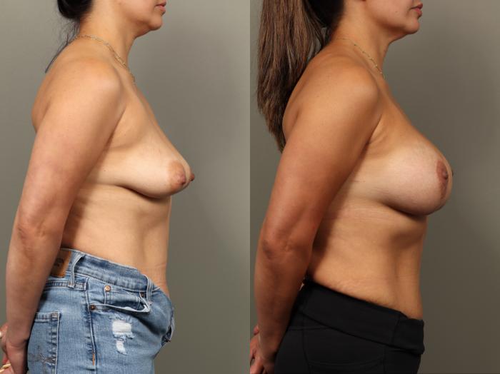 Before & After Breast Augmentation with Breast Lift  Case 476 Right Side View in Gilbert, AZ