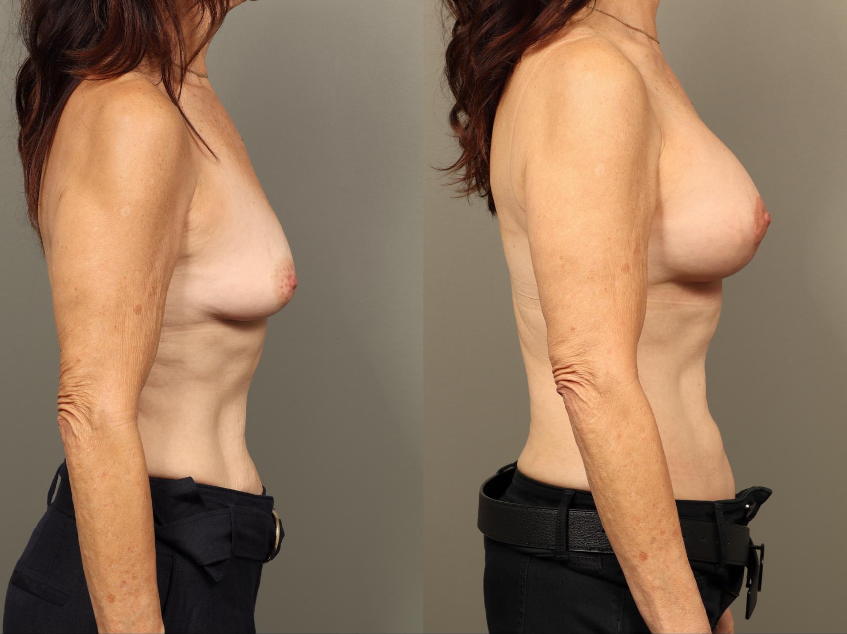 Before & After Breast Augmentation with Breast Lift  Case 506 Left Side View in Gilbert, AZ