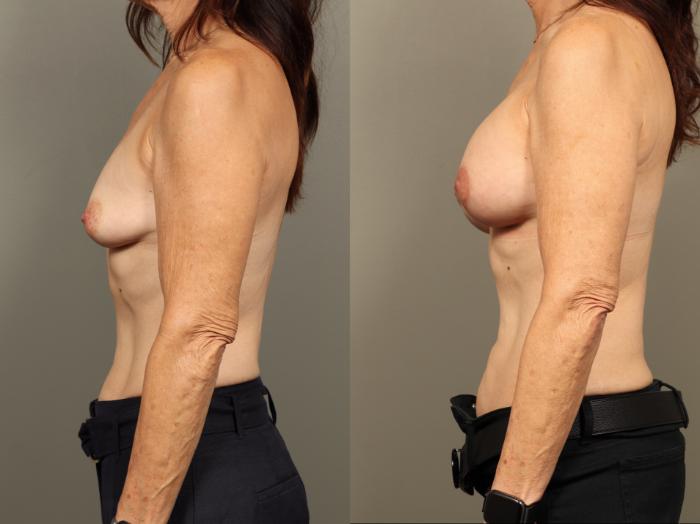 Before & After Breast Augmentation with Breast Lift  Case 506 Right Side View in Gilbert, AZ