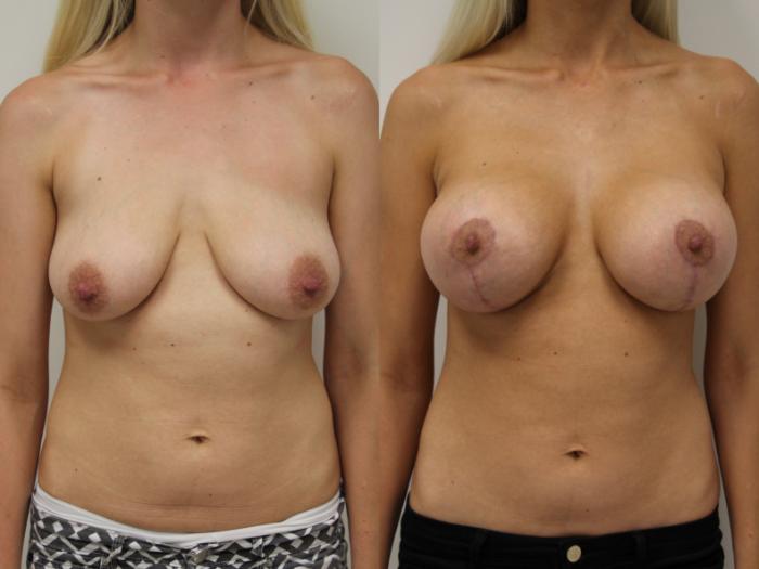 Before & After Breast Augmentation with Breast Lift  Case 57 View #1 View in Gilbert, AZ