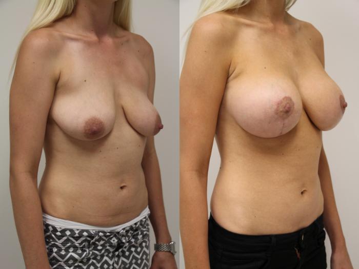 Before & After Breast Augmentation with Breast Lift  Case 57 View #2 View in Gilbert, AZ