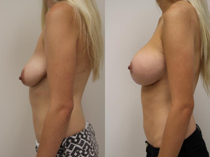 Before & After Breast Augmentation with Breast Lift  Case 57 View #3 View in Gilbert, AZ