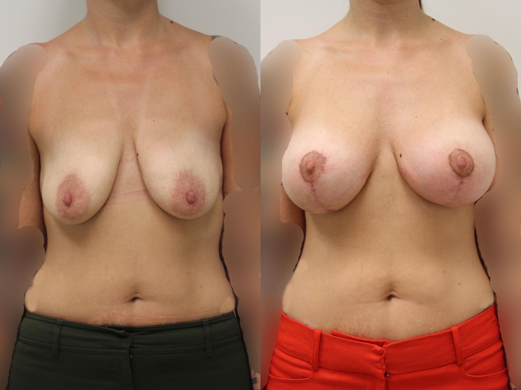 Before & After Breast Augmentation with Breast Lift  Case 8 View #1 View in Gilbert, AZ