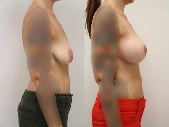 Before & After Breast Augmentation with Breast Lift  Case 8 View #2 View in Gilbert, AZ