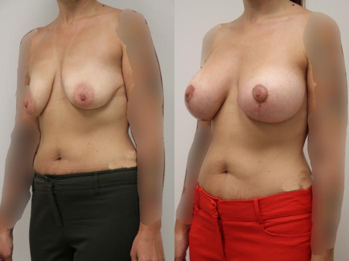 Before & After Breast Augmentation with Breast Lift  Case 8 View #3 View in Gilbert, AZ