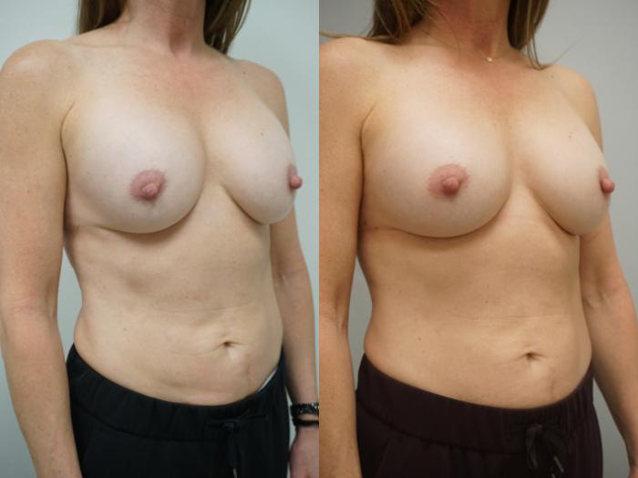 Before & After Breast Implant Exchange Case 144 View #1 View in Gilbert, AZ