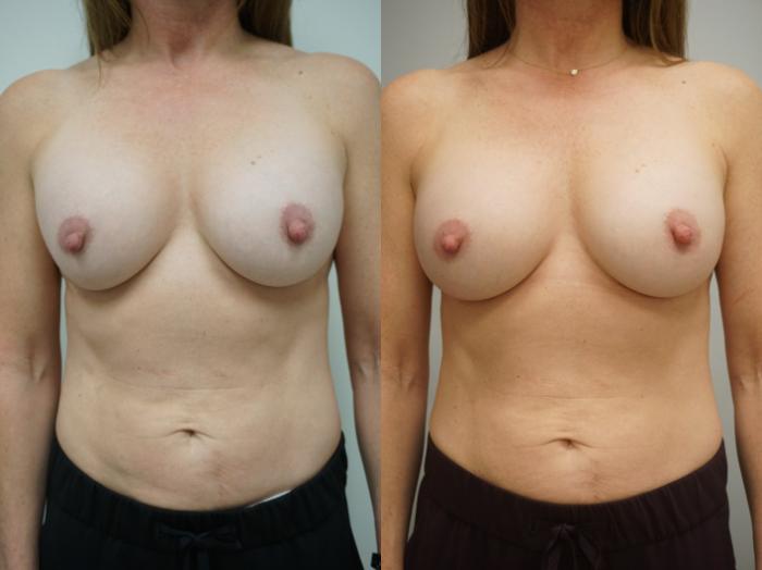 Before & After Breast Implant Exchange Case 144 View #2 View in Gilbert, AZ