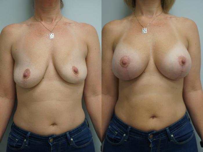 Before & After Breast Implant Exchange Case 174 View #1 View in Gilbert, AZ