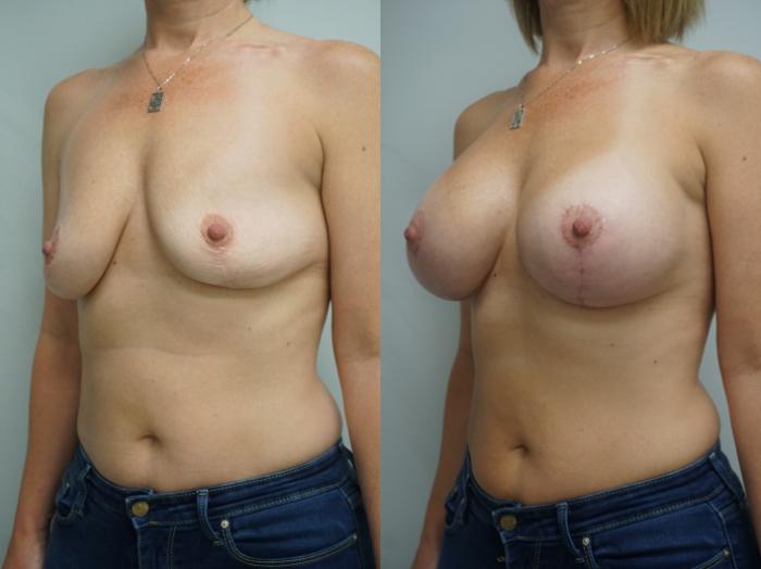 Before & After Breast Implant Exchange Case 174 View #2 View in Gilbert, AZ