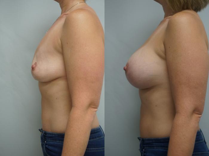 Before & After Breast Implant Exchange Case 174 View #3 View in Gilbert, AZ