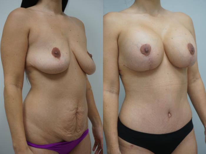 Before & After Breast Implant Exchange Case 190 View #1 View in Gilbert, AZ