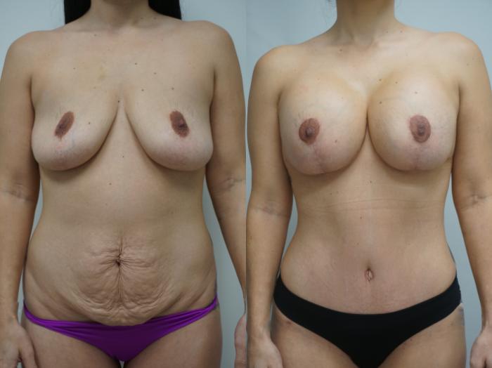 Before & After Breast Implant Exchange Case 190 View #2 View in Gilbert, AZ