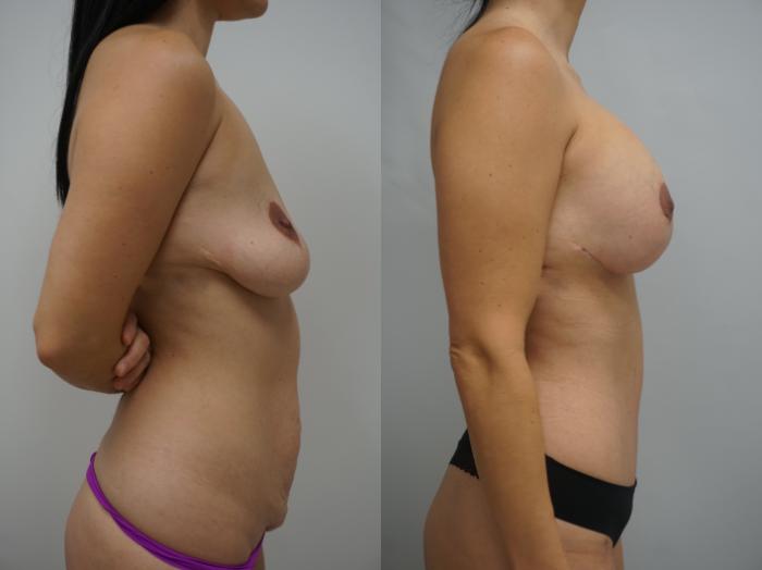 Before & After Breast Implant Exchange Case 190 View #3 View in Gilbert, AZ